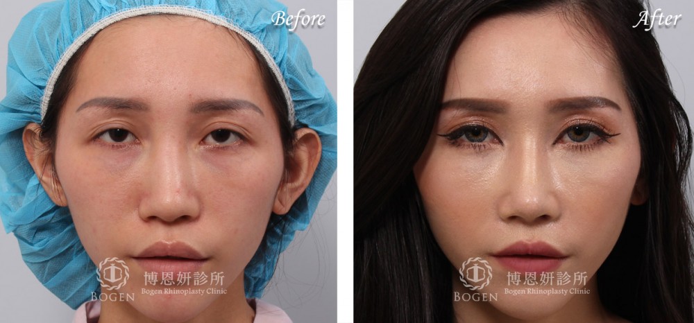 博恩妍診所張簡醫師晶亮瓷清除自體肋軟骨異體真皮鼻重修案例
